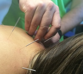acupuntura