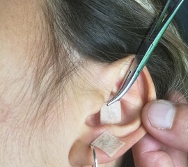 auriculoterapia